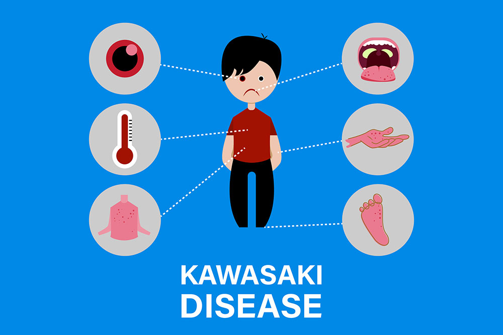 Kawasaki disease – causes and symptoms